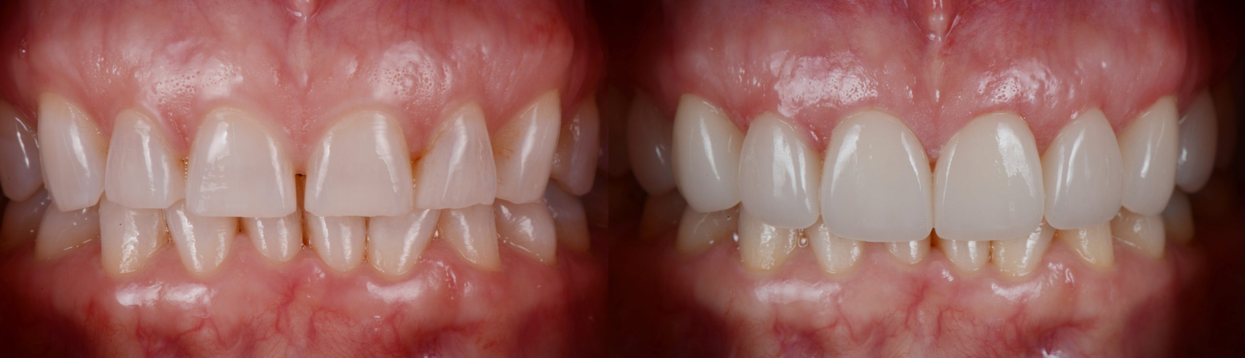 Resultaat van een cosmetische behandeling met facings bij de tandarts in Hoofddorp