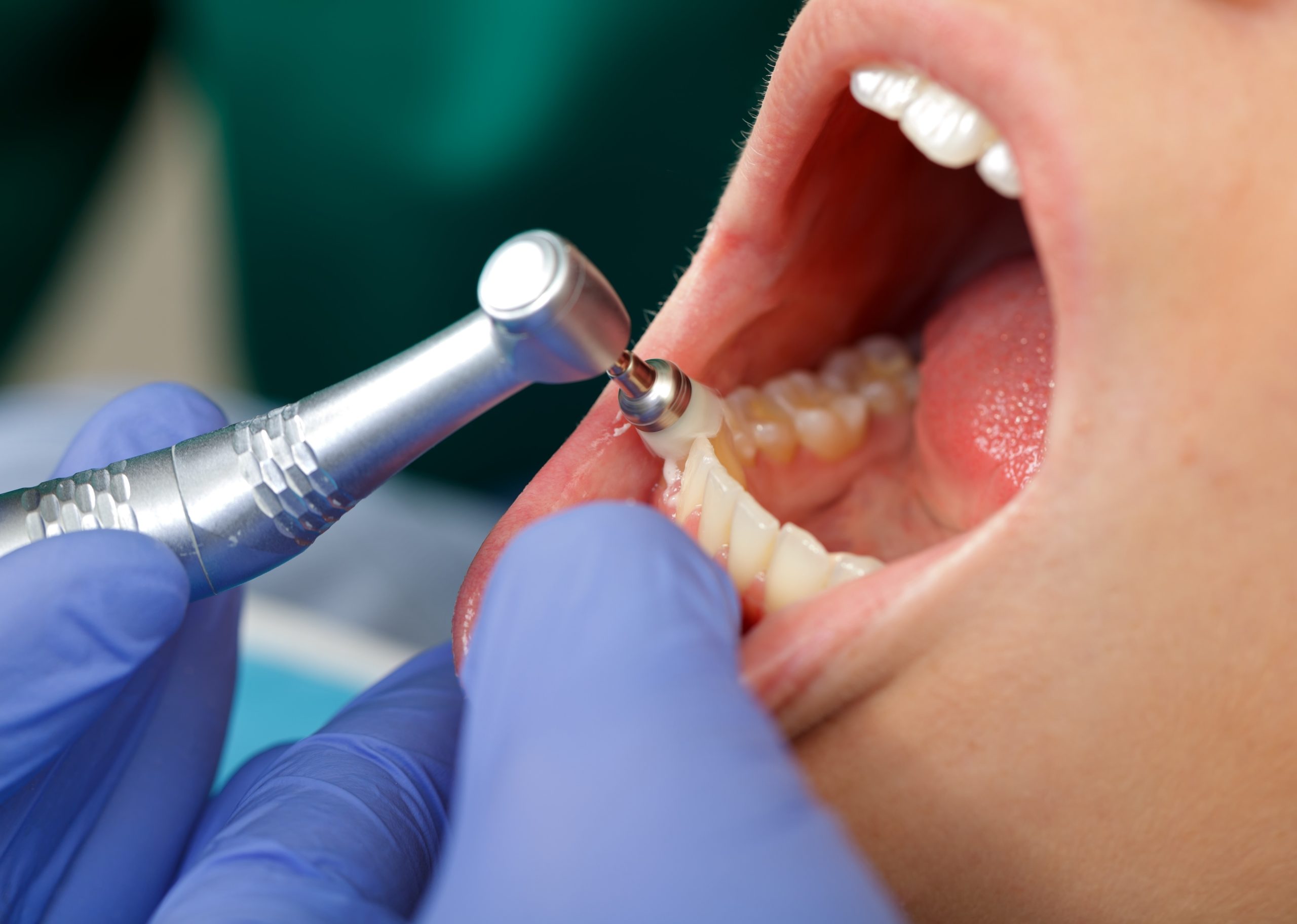 Professionele gebitsreiniging door de mondhygiënist in Hoofddorp